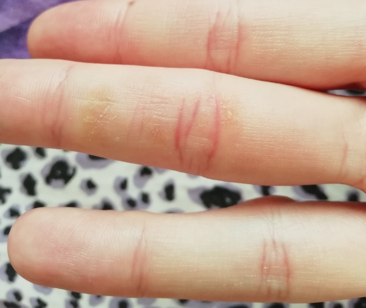 Аллергические покраснения на пальцах