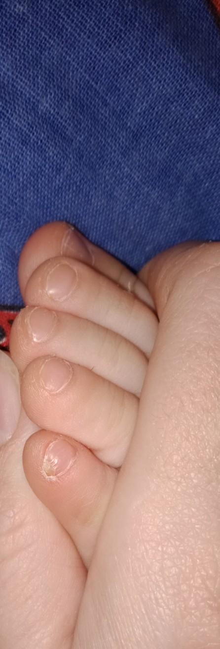 Вросший ноготь и другие проблемы с ногтями младенцев | Клиника Рассвет