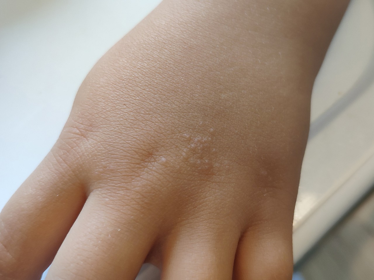 Сыпь на кисти у ребенка - Вопрос дерматологу - 03 Онлайн