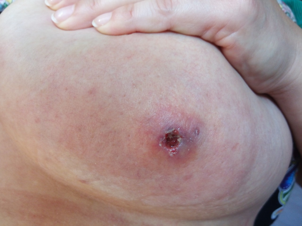 фурункул на груди у женщин лечение фото 21