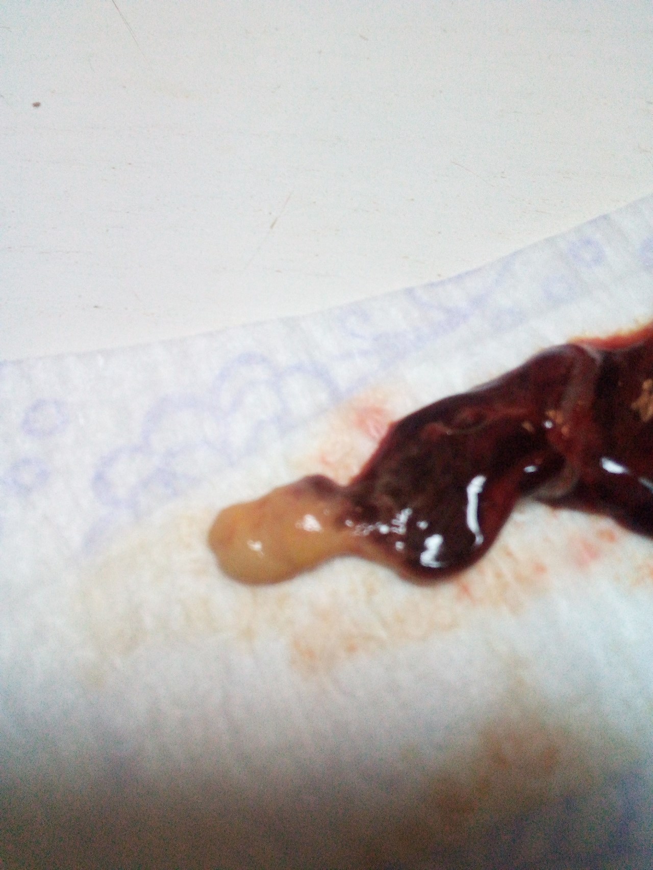 кровяные сгустки в сперме у мужчин фото 30