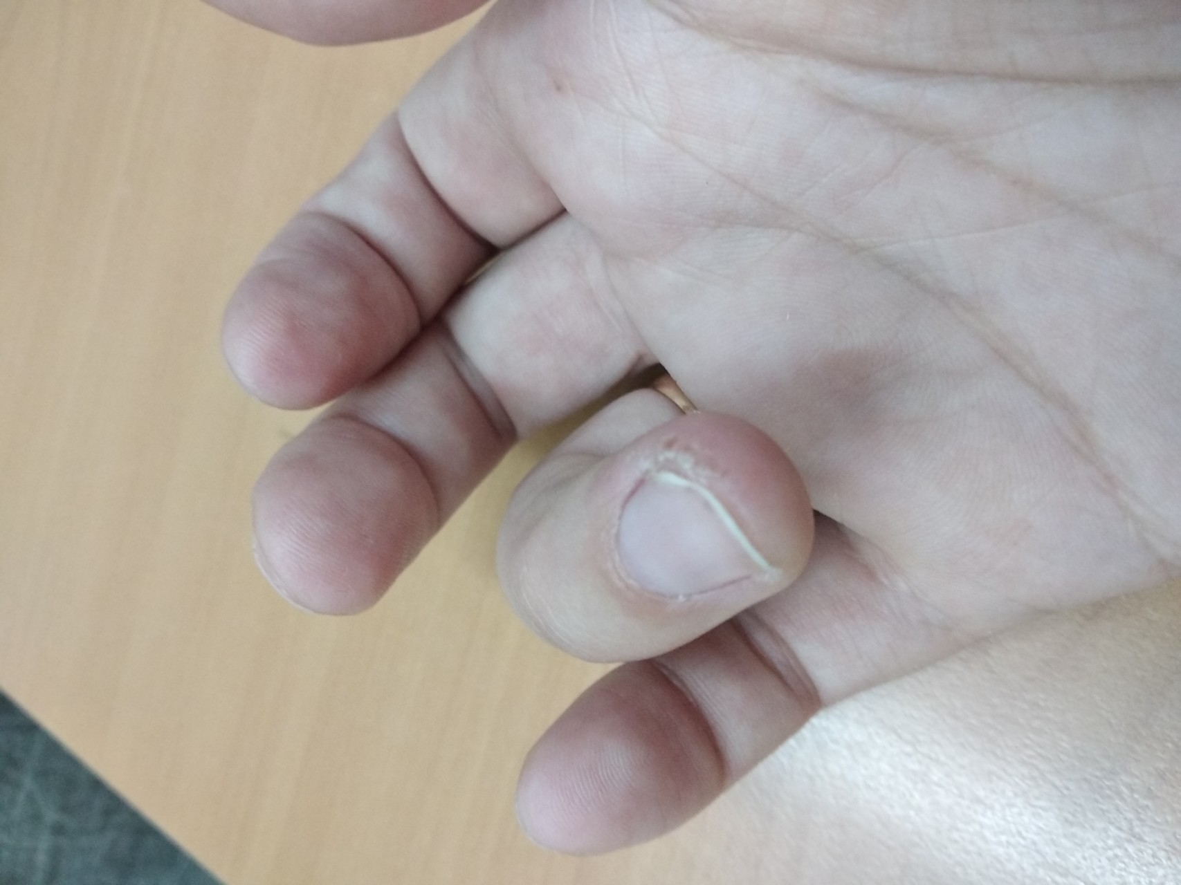 Утолщение ногтя на пальце