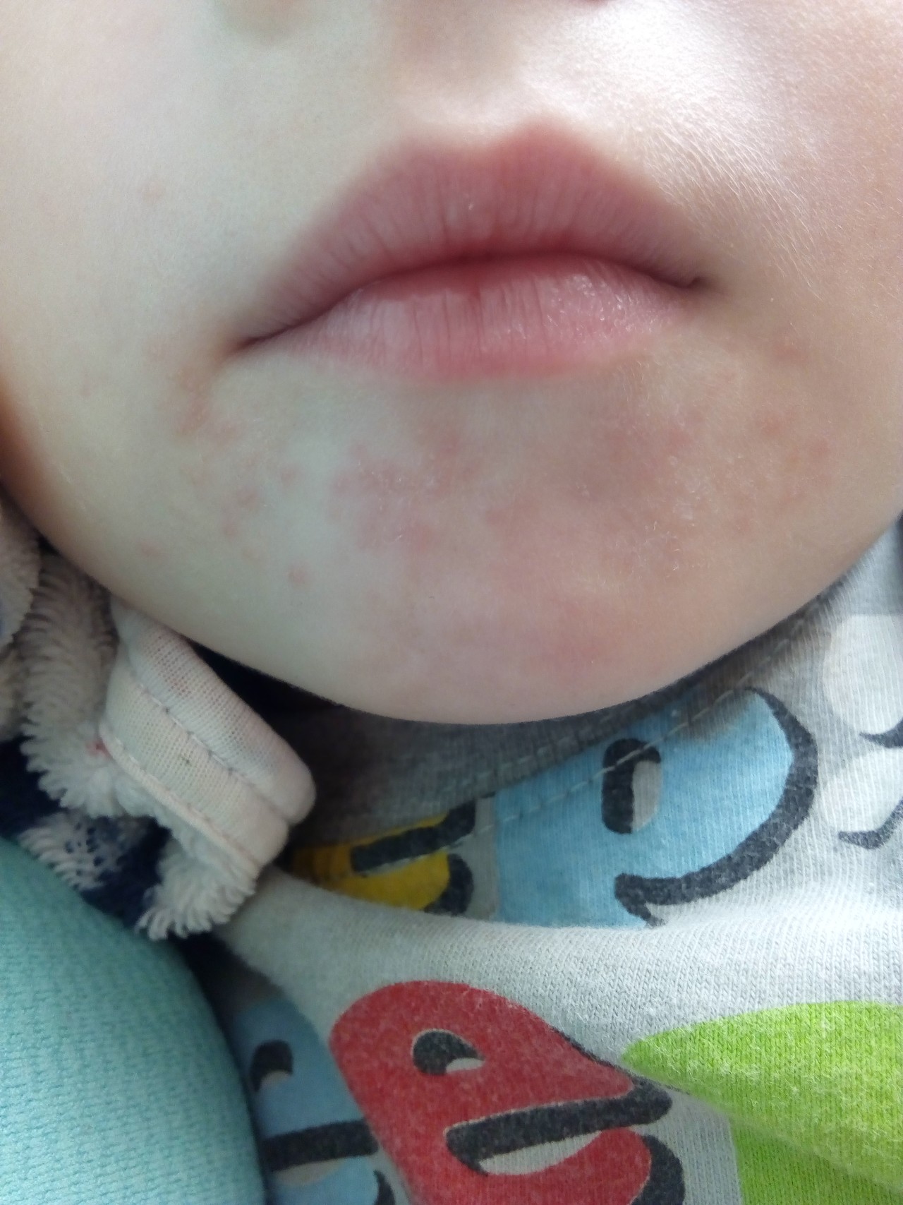 Атопич. Атопический периоральный дерматит. Периоральный дерматит у грудничка. Аллергический дерматит на лице у ребенка.
