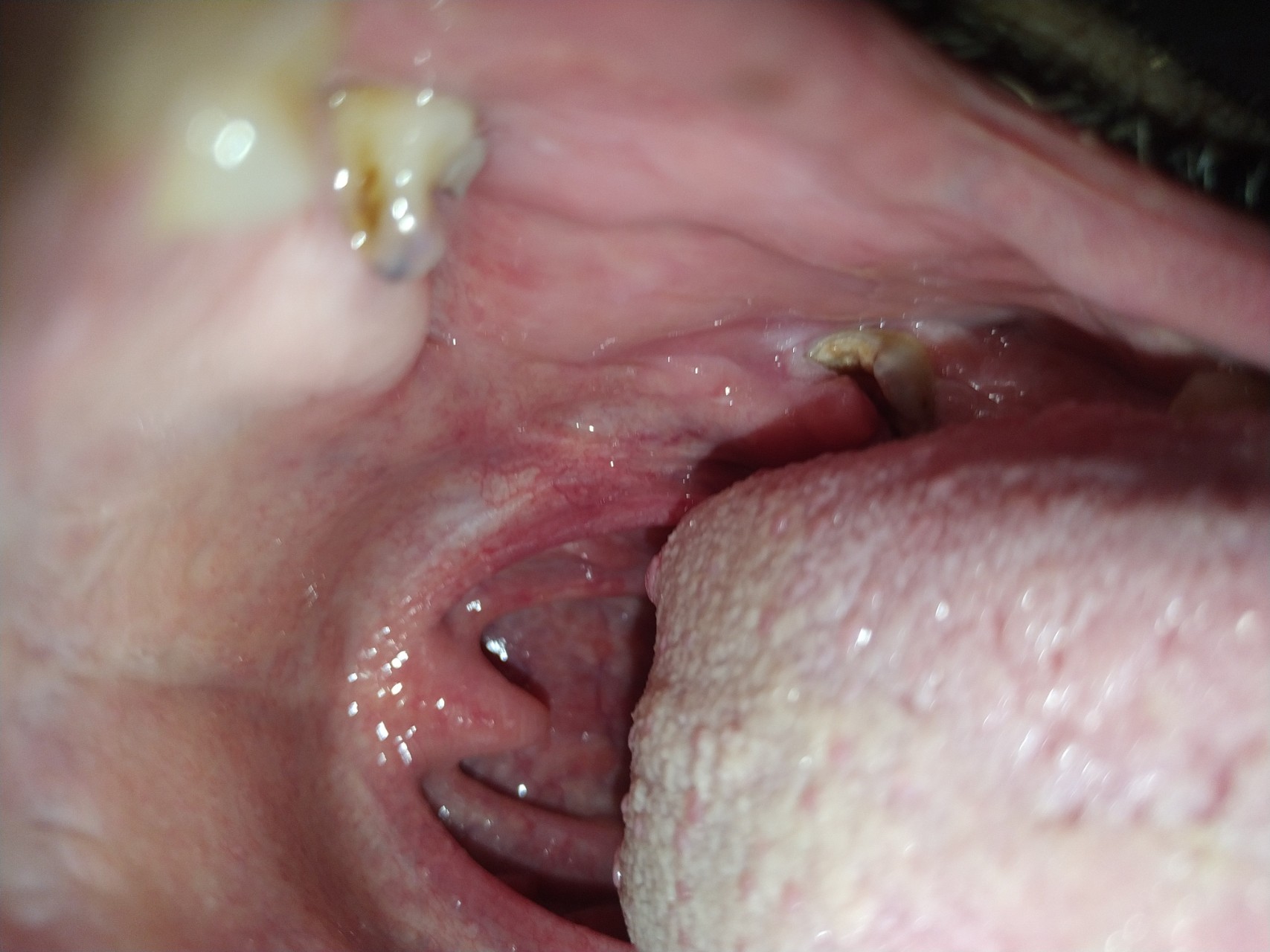 Tonsillitis from oral sex