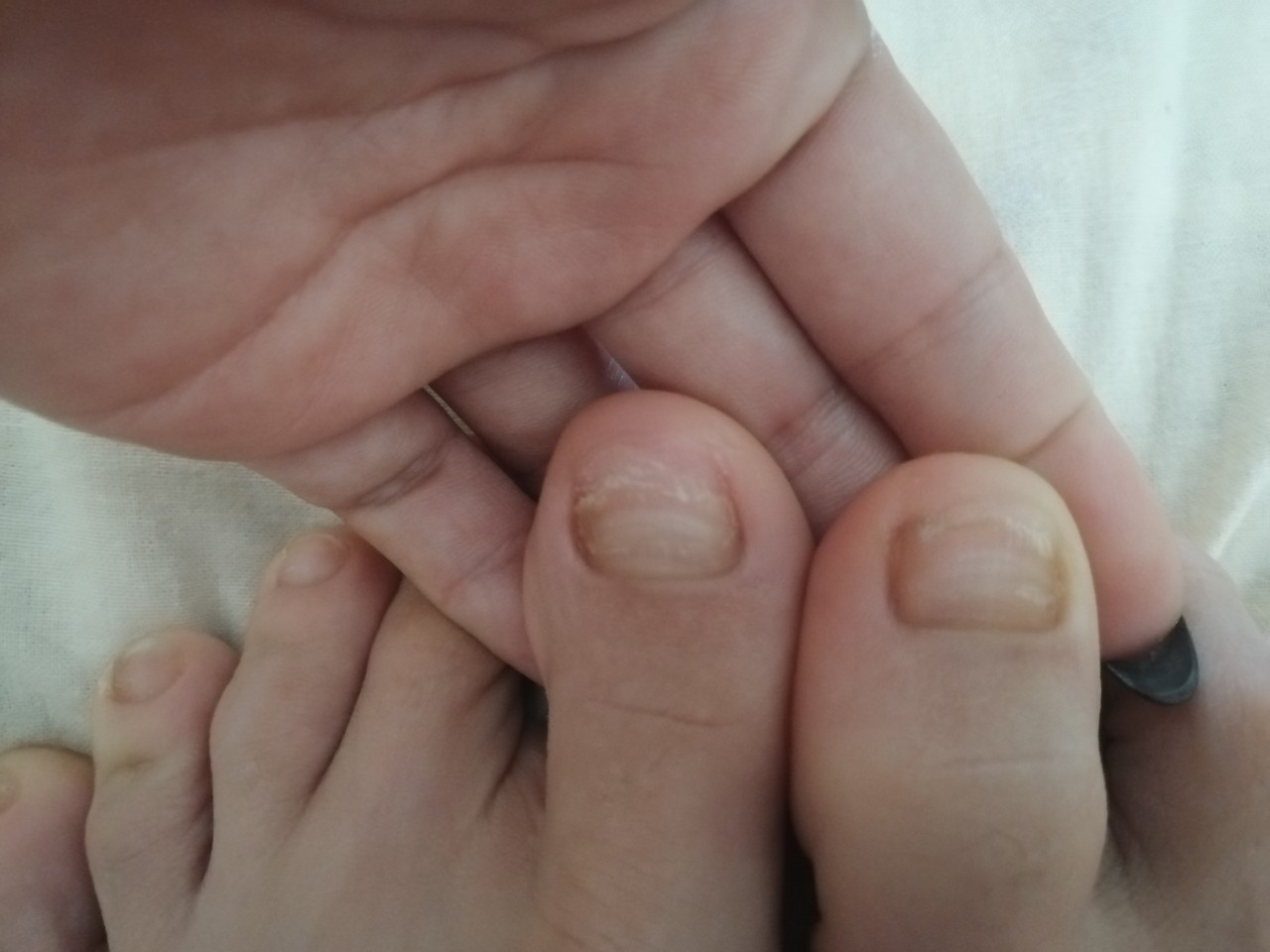 Волнистые ногти на ногах у ребенка