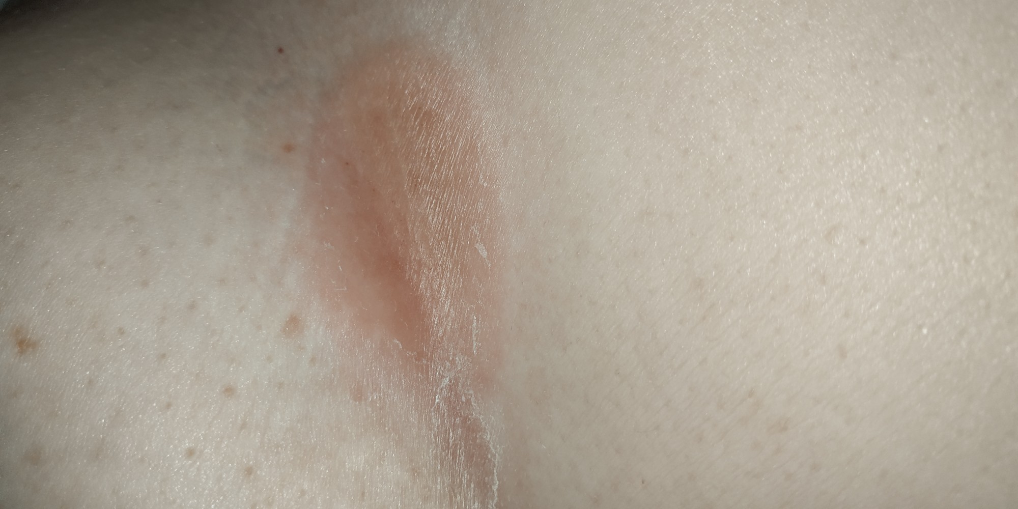 кожа груди чешется у женщин фото 105
