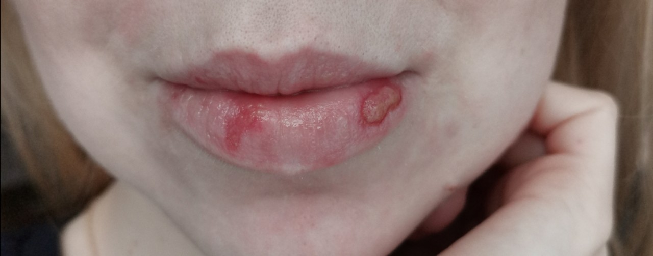 Незаживающая рана на губе после герпеса.