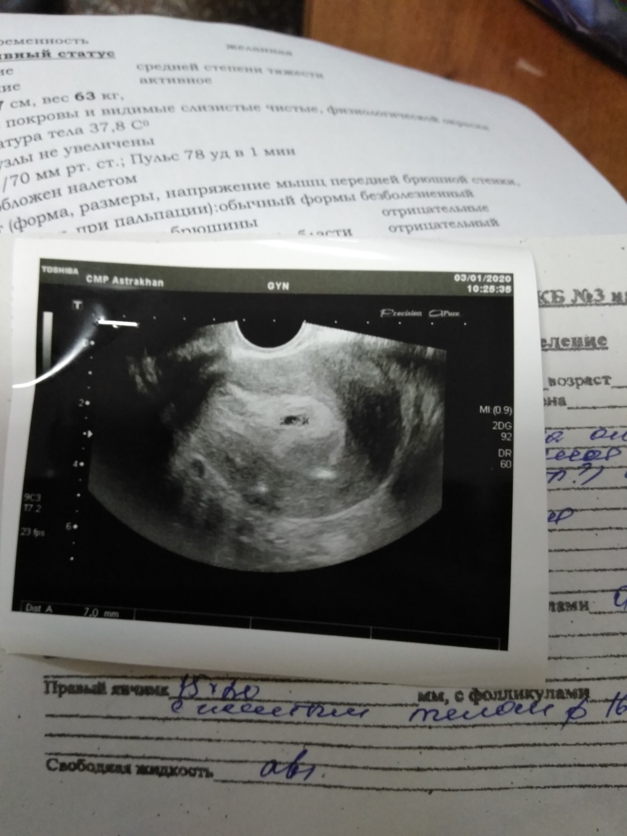 УЗИ 5 недели беременност6