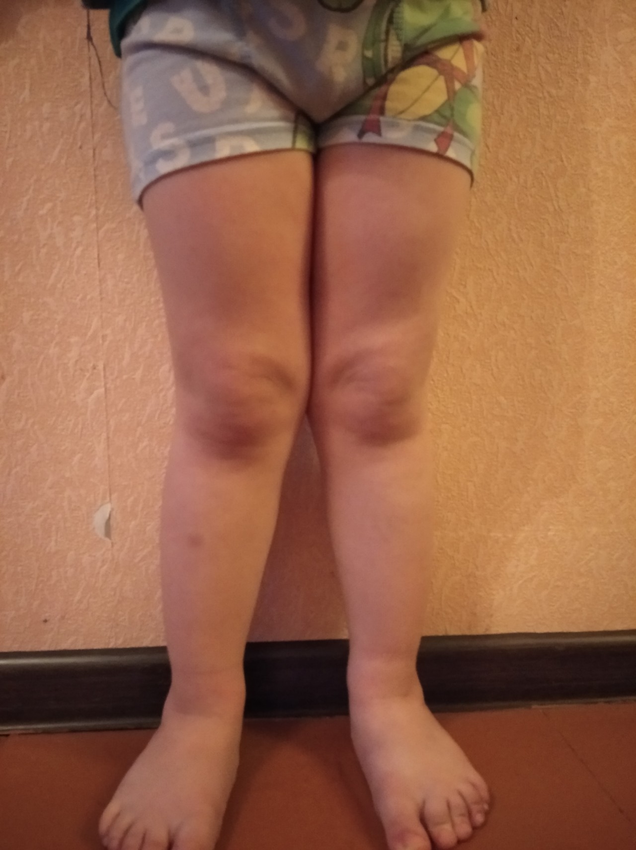 Вальгусная деформация коленных суставов