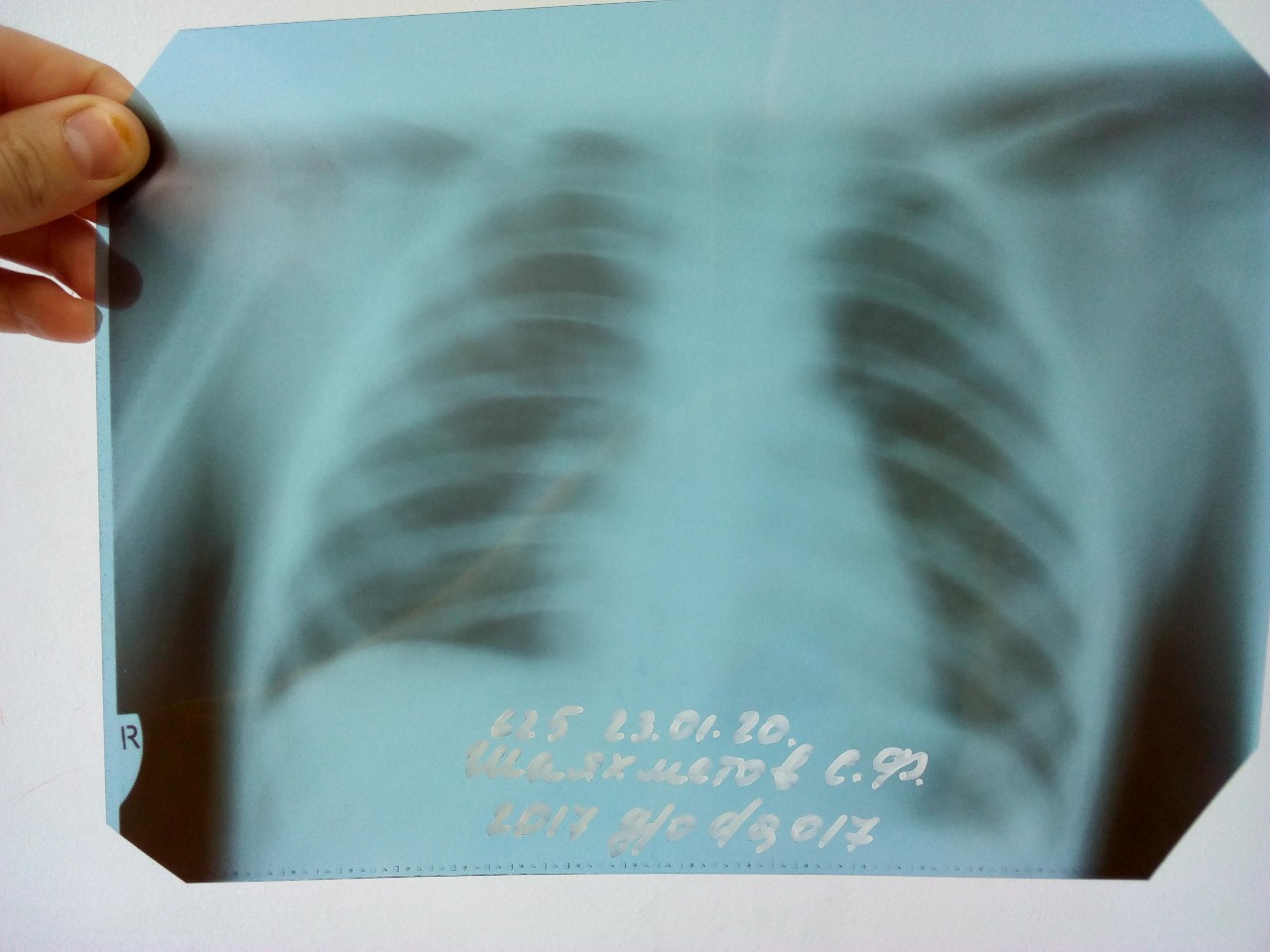Рентгенонегативная пневмония
