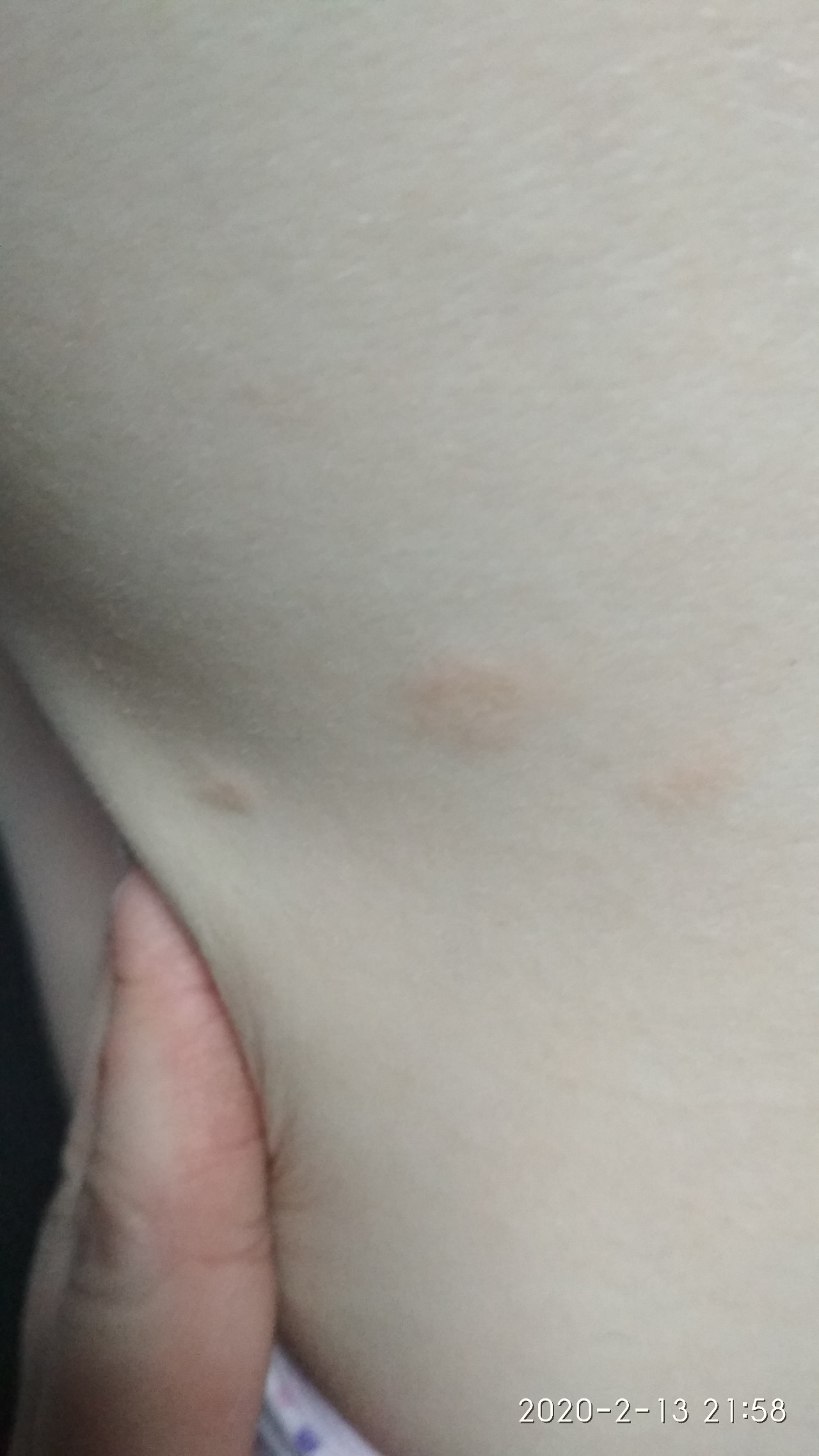 светло коричневые пятна на груди у женщин фото 112