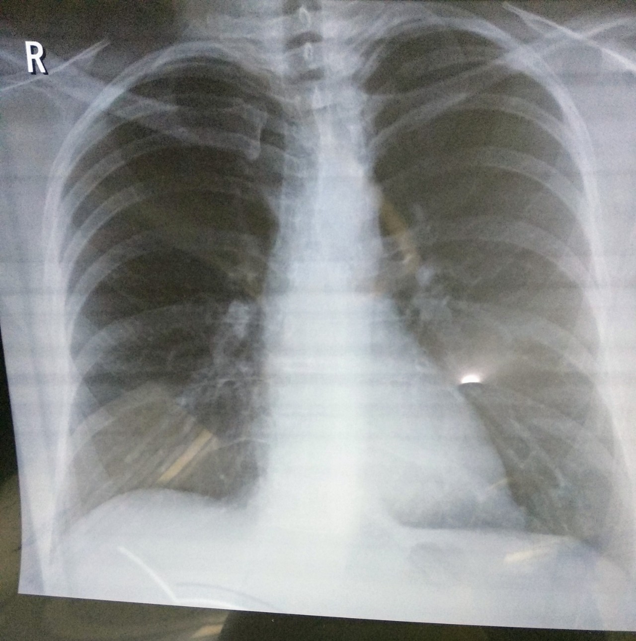 Рентген легких пневмония covid19