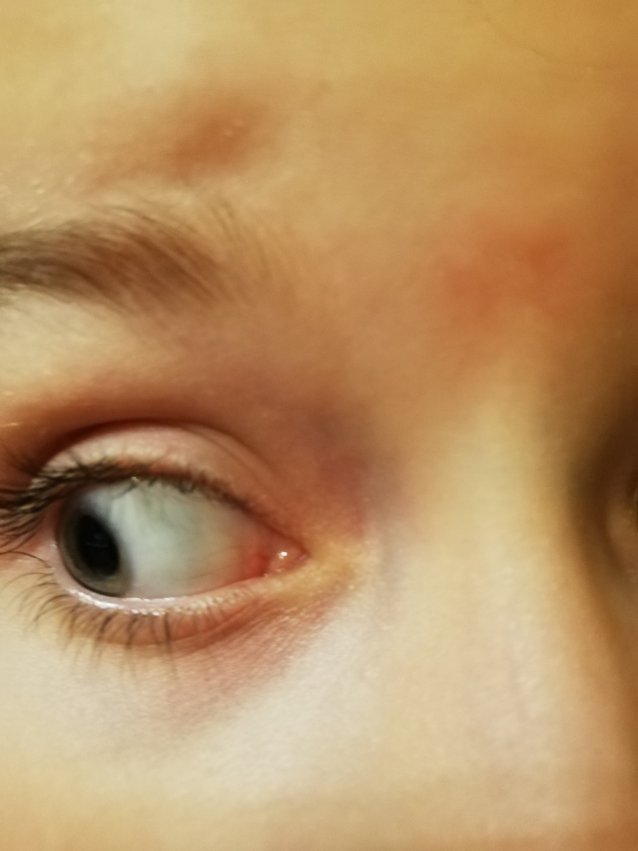 Eye corner. Конъюнктивит халязион. Покраснение в уголке глаза. Воспаление в уголке глаза.