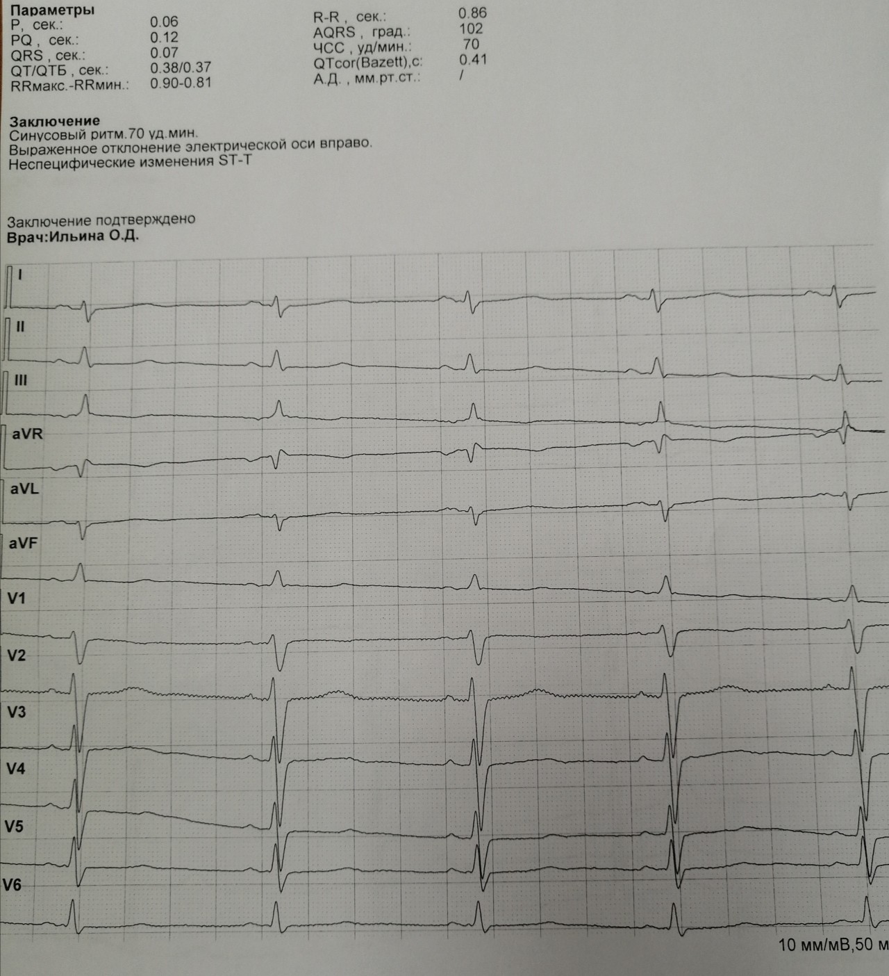 Отклонения на экг. ЭКГ отклонение параметров QRS 111. Отклонение параметров QRS на ЭКГ v3. V4. Отклонение параметров QRS III что это. ЭКГ отклонения параметров QRS AVR.