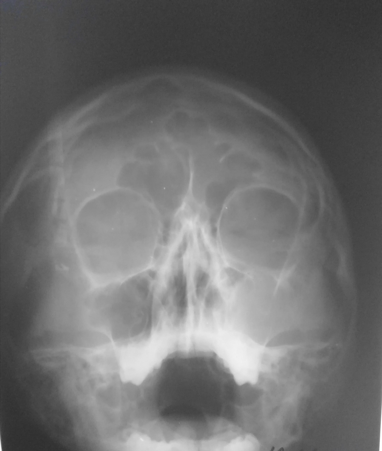 Гайморова пазуха. Верхнечелюстной синусит рентген. Рентген пазух носа субтотальное затемнение. Верхнечелюстная гайморова пазуха. Полип гайморовой пазухи рентген.