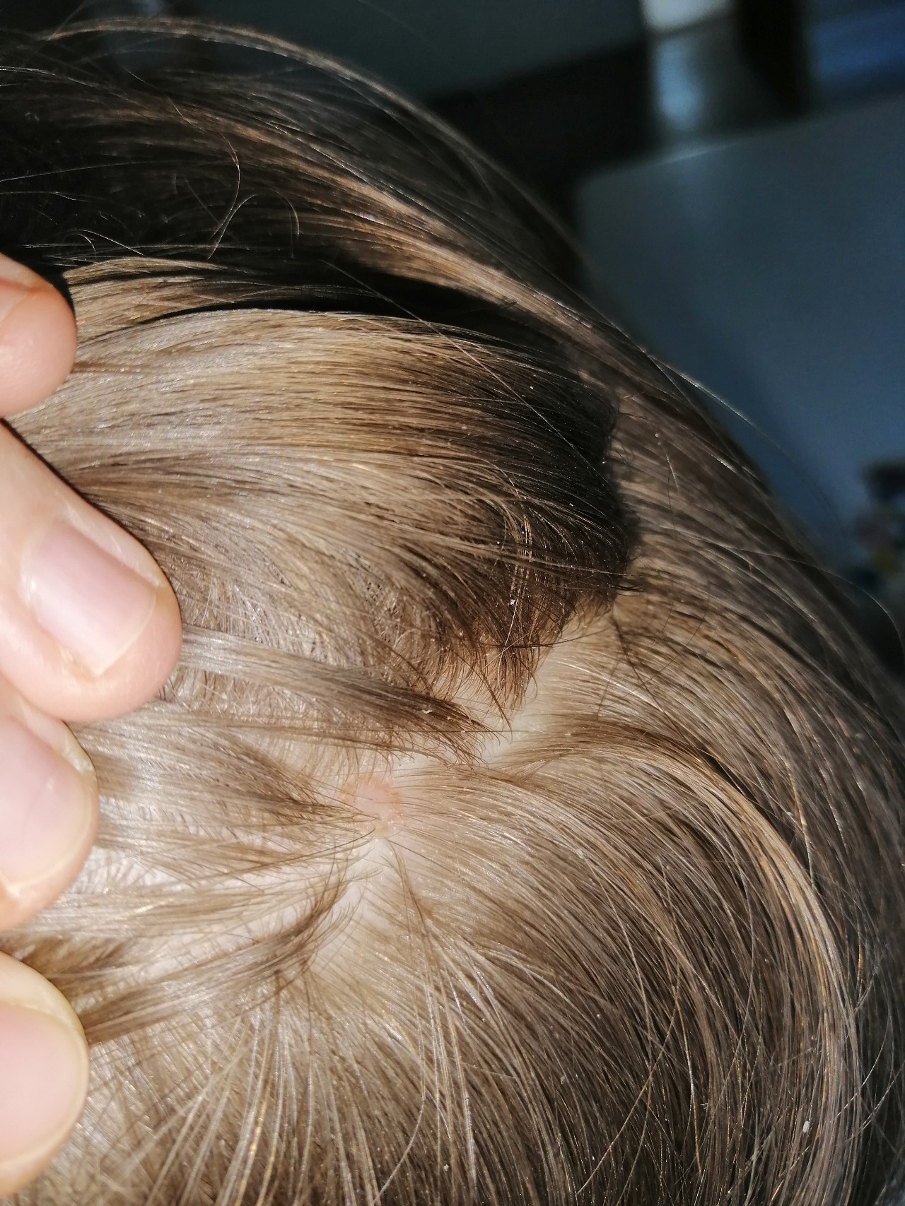 Пятна на волосистой части головы у ребенка