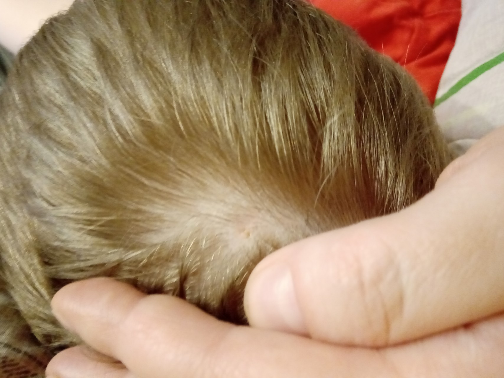 Из за чего у детей выпадают очагами волосы на голове