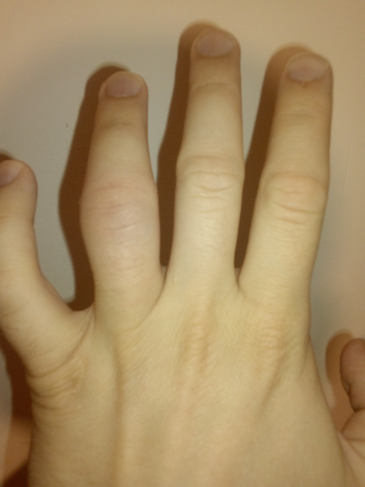 Сильно болят пальцы на руках. Перелом указательного пальца.