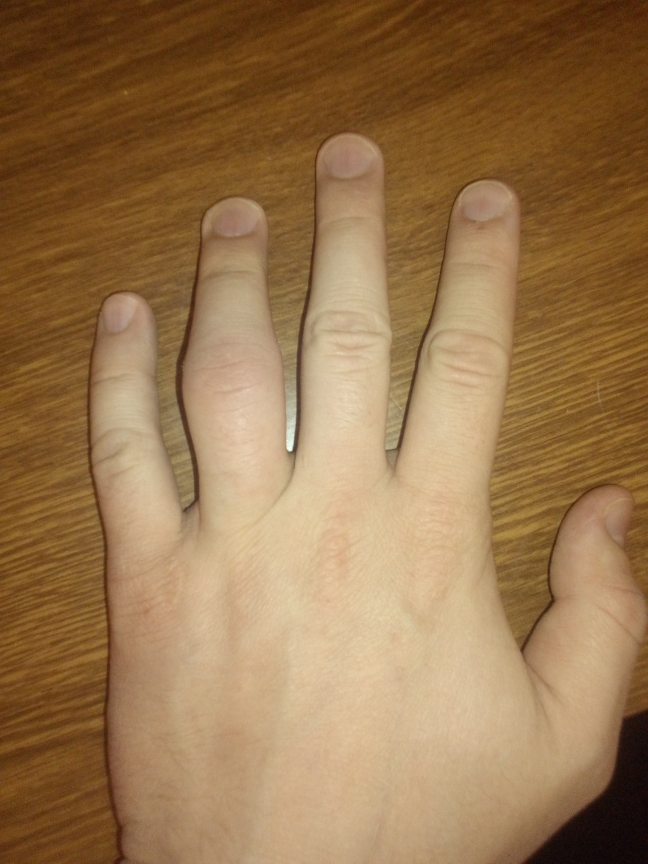 фото посиневших пальцев