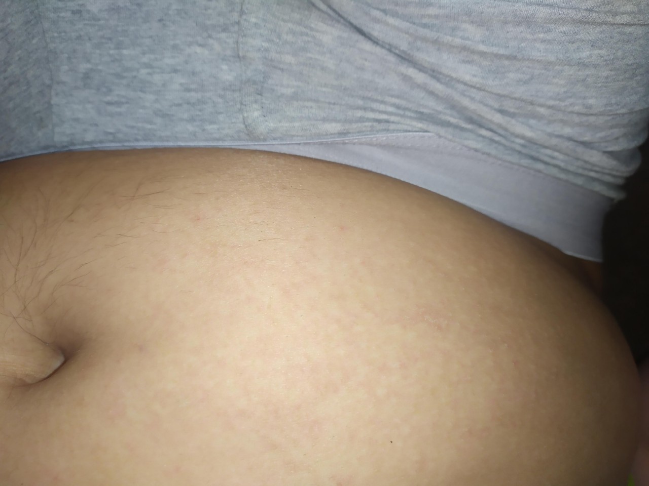 беременность сыпь на животе и груди фото 73
