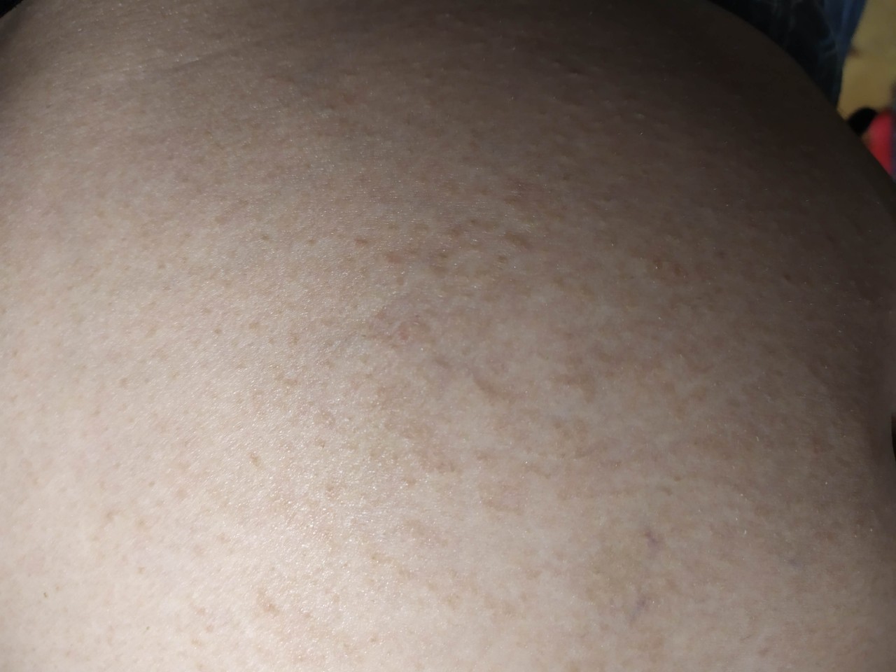 сыпь на коже груди у женщин фото 96