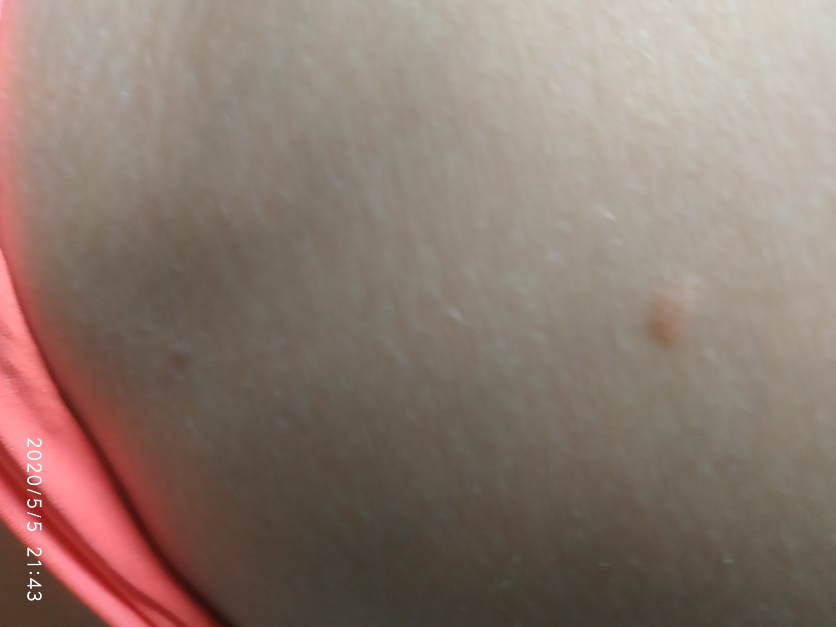 красная сыпь на груди во время беременности фото 59