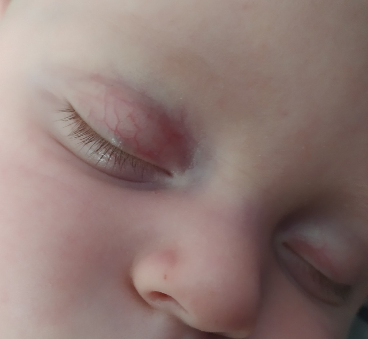 Покраснение глаз у детей | Клиника Фэнтези