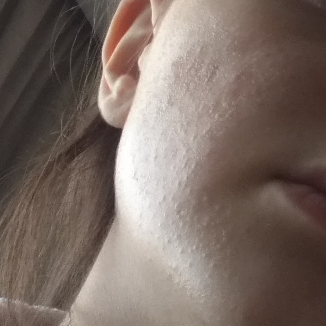 Мелкая бесцветная сыпь на лице у женщин