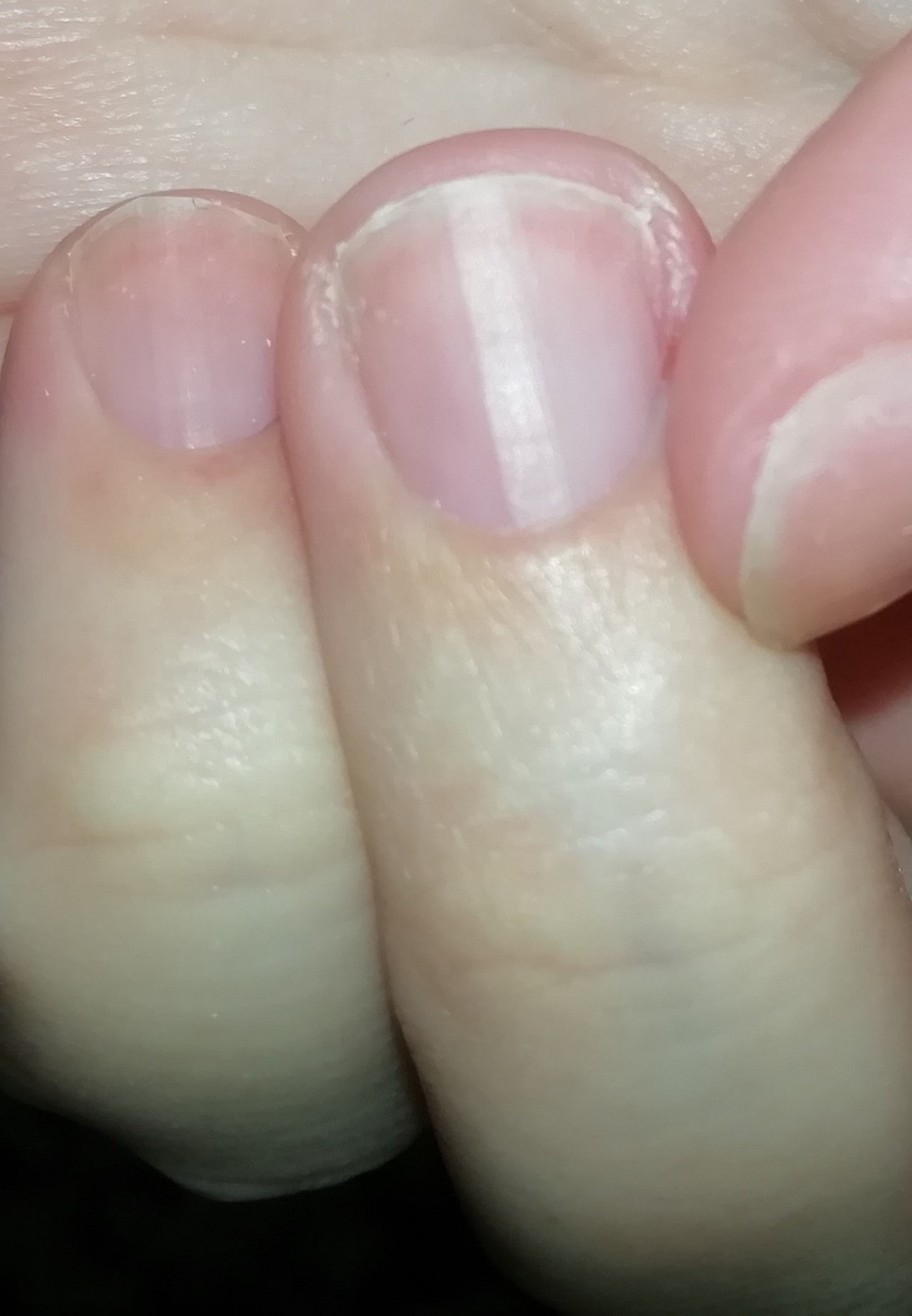 Что такое птеригий на ногтях фото