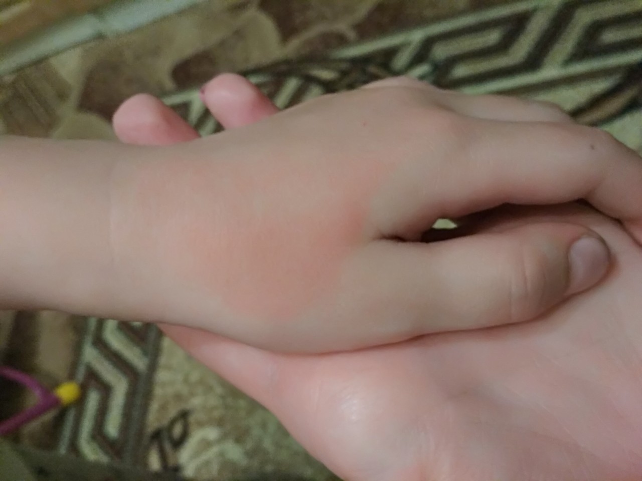 Пятнышки на руке у ребенка