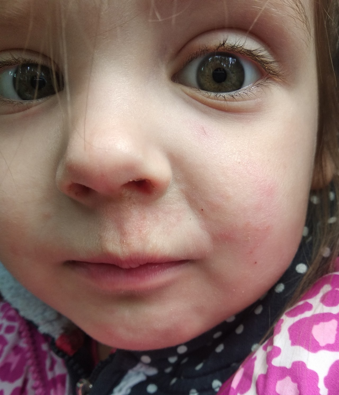 Ребенку год красные щеки. Красные пятна на лице у ребенка. Пятнышко на лице у ребенка.