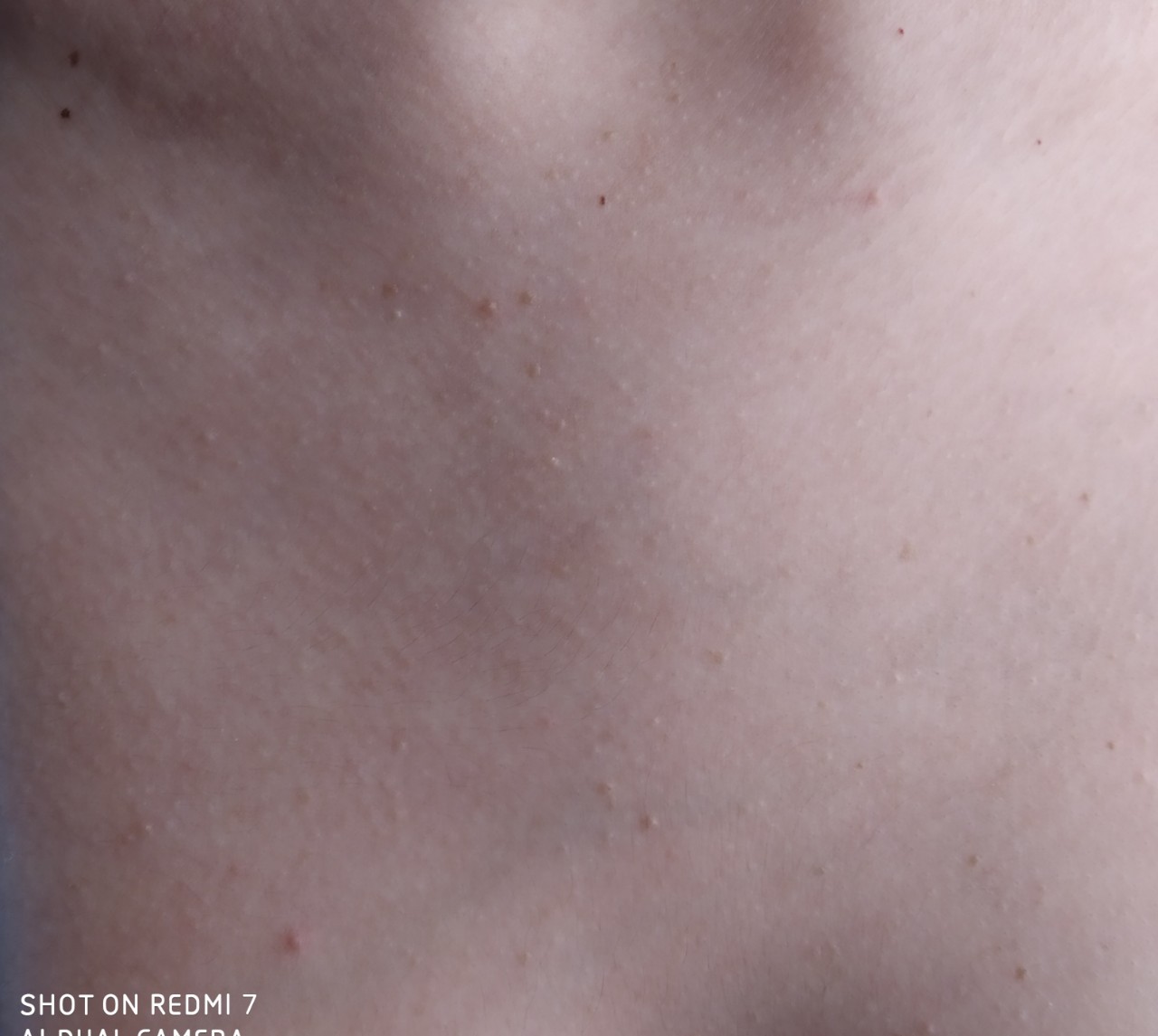 красная сыпь на груди у мужчин причины (120) фото