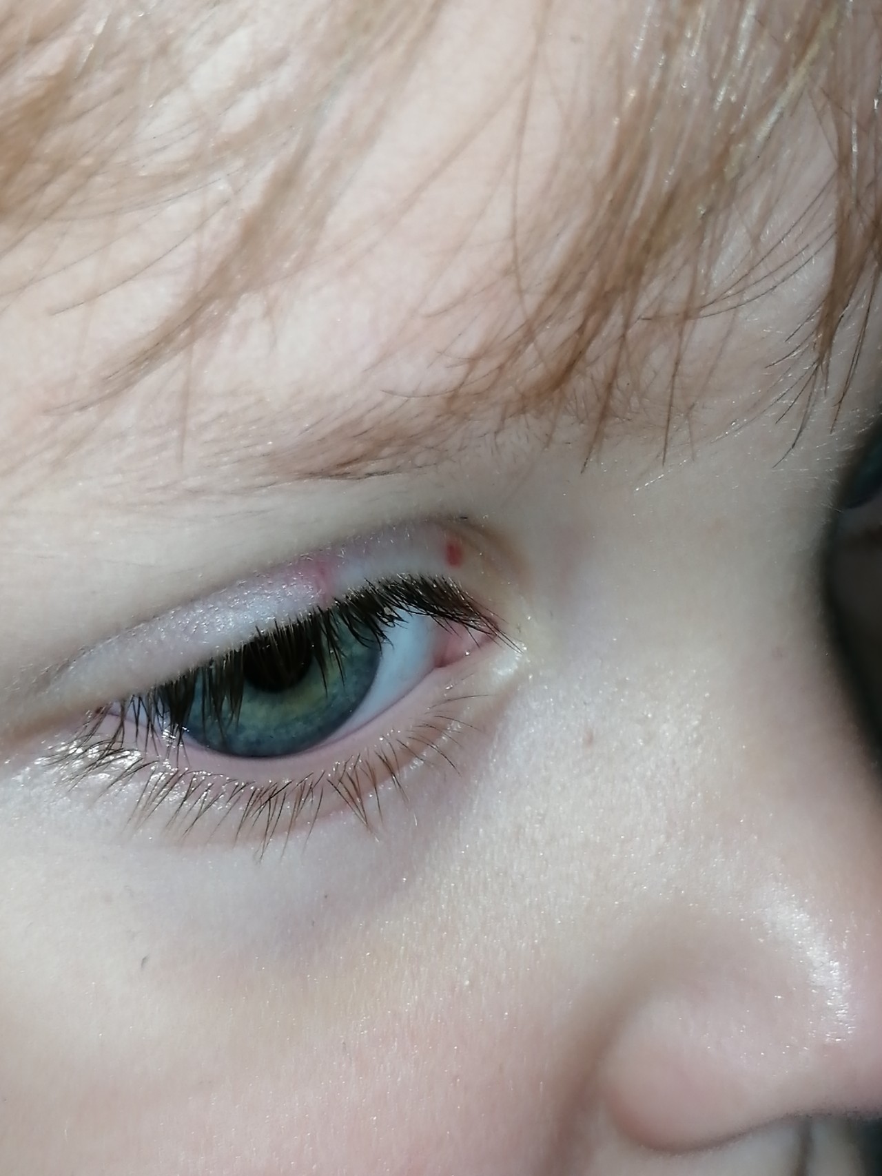 Точки около глаз. Пятнышко под глазом у ребенка. Красное пятнышко на глазу у ребенка.