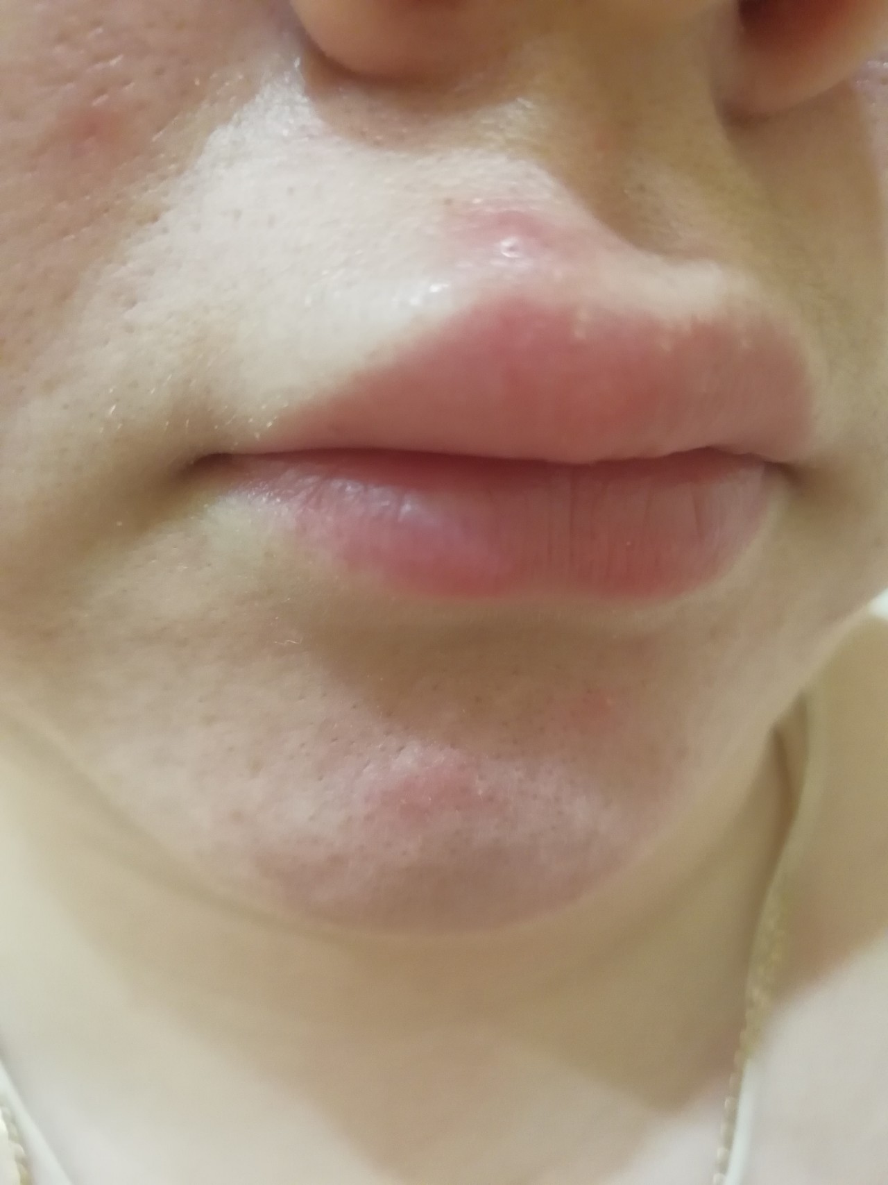 Причины опухания нижней губы