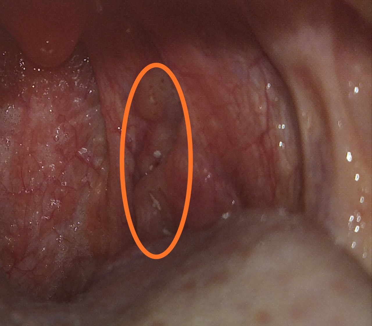 Klebsiella (клебсиелла)