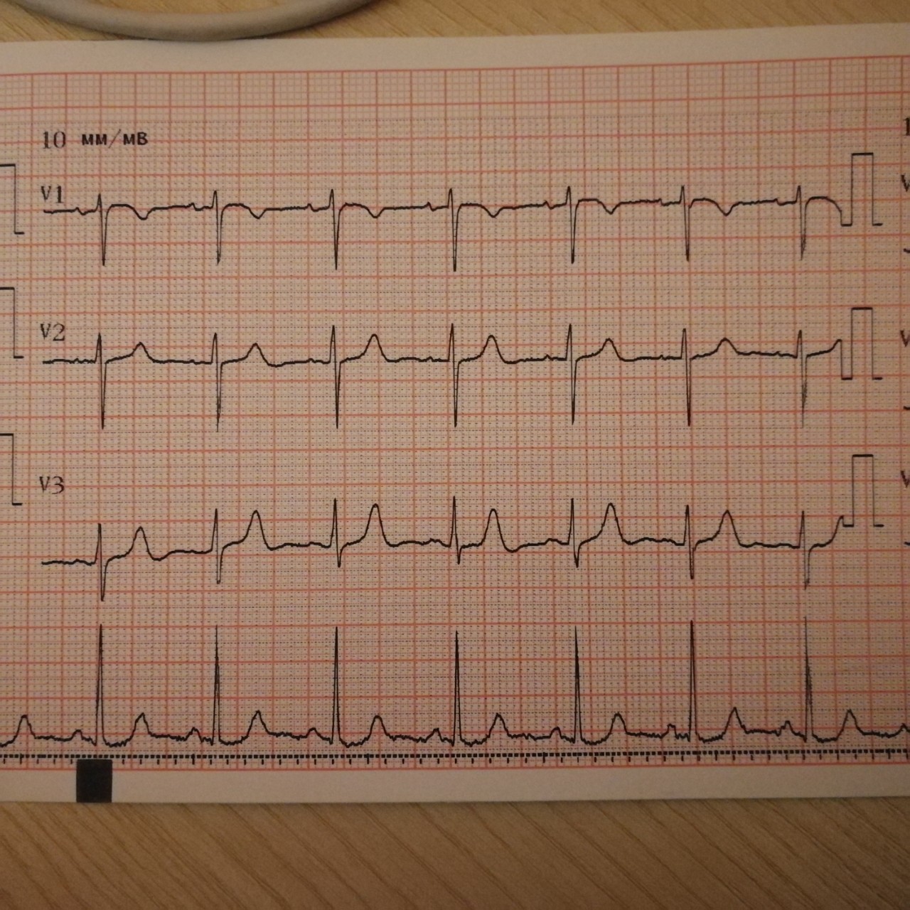 Экг сочи. ЭКГ электрокардиограмма сердца. Нормальная кардиограмма здорового человека. ЭКГ 2022. ЭГГ здорового человека.