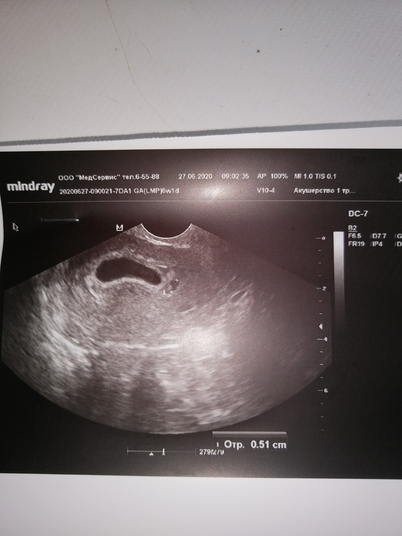 6 недель изменения. 6 Недель беременности ущиузи. УЗИ 6 недель беременности. Фото УЗИ на 6 неделе беременности акушерской. УЗИ на 5-6 неделе беременности акушерская.