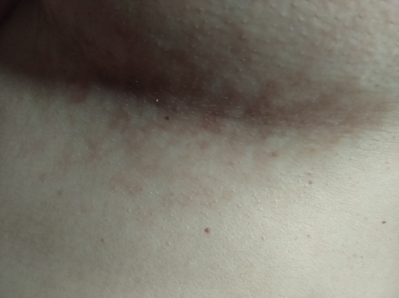 красная сыпь на груди при беременности фото 21