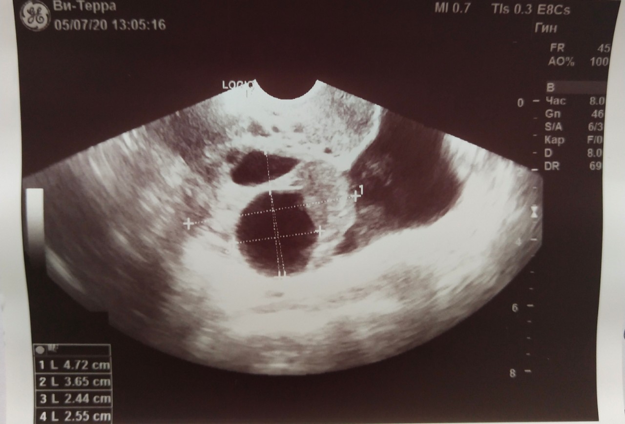 у меня перестала болеть грудь беременность 5 6 недель фото 53