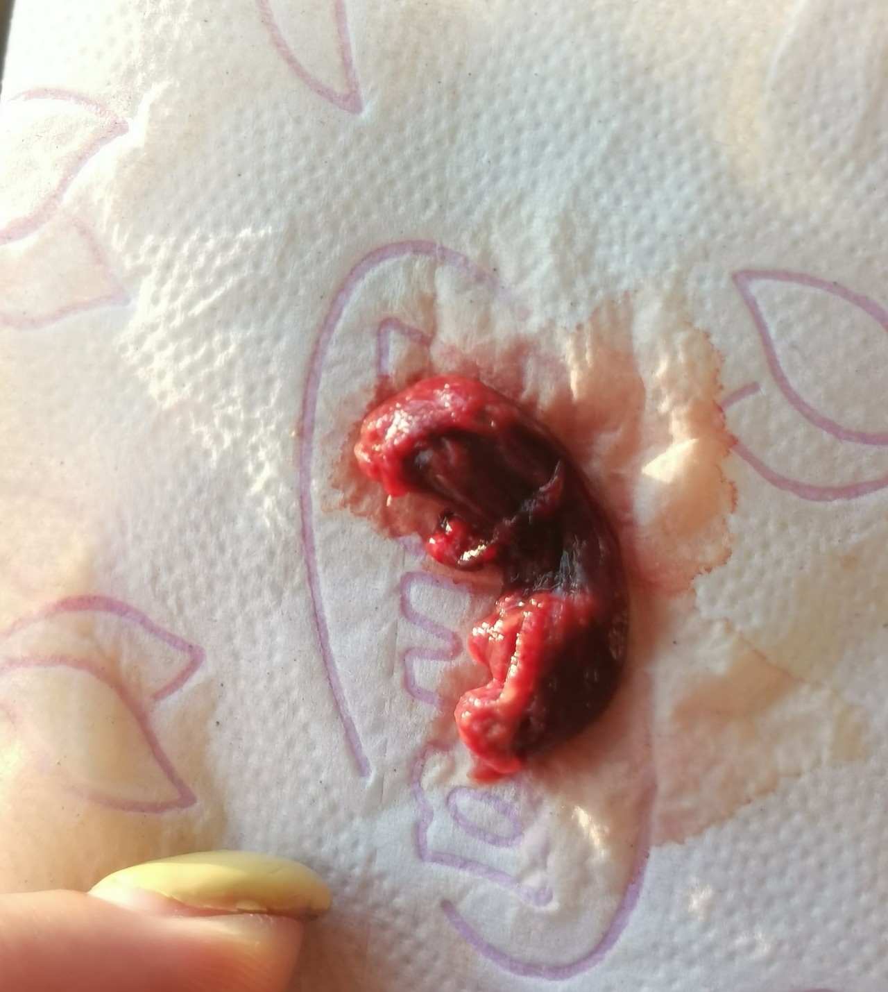 кровянистые выделения из груди беременность фото 42