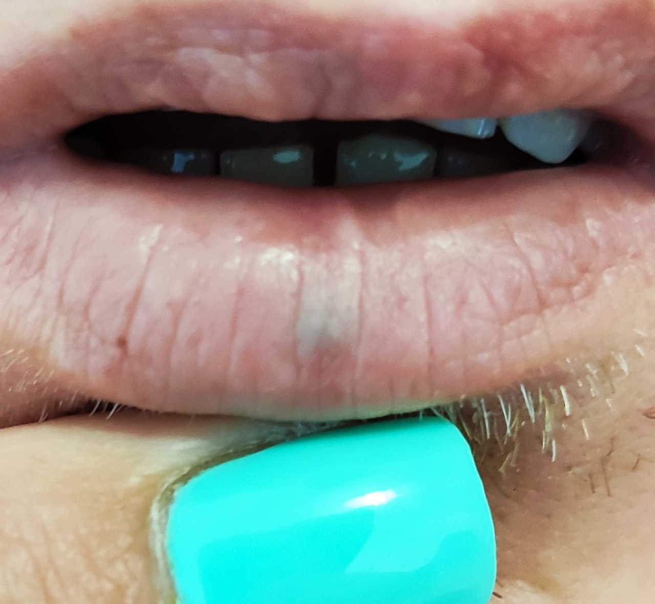 Синяя шишка на нижней губе