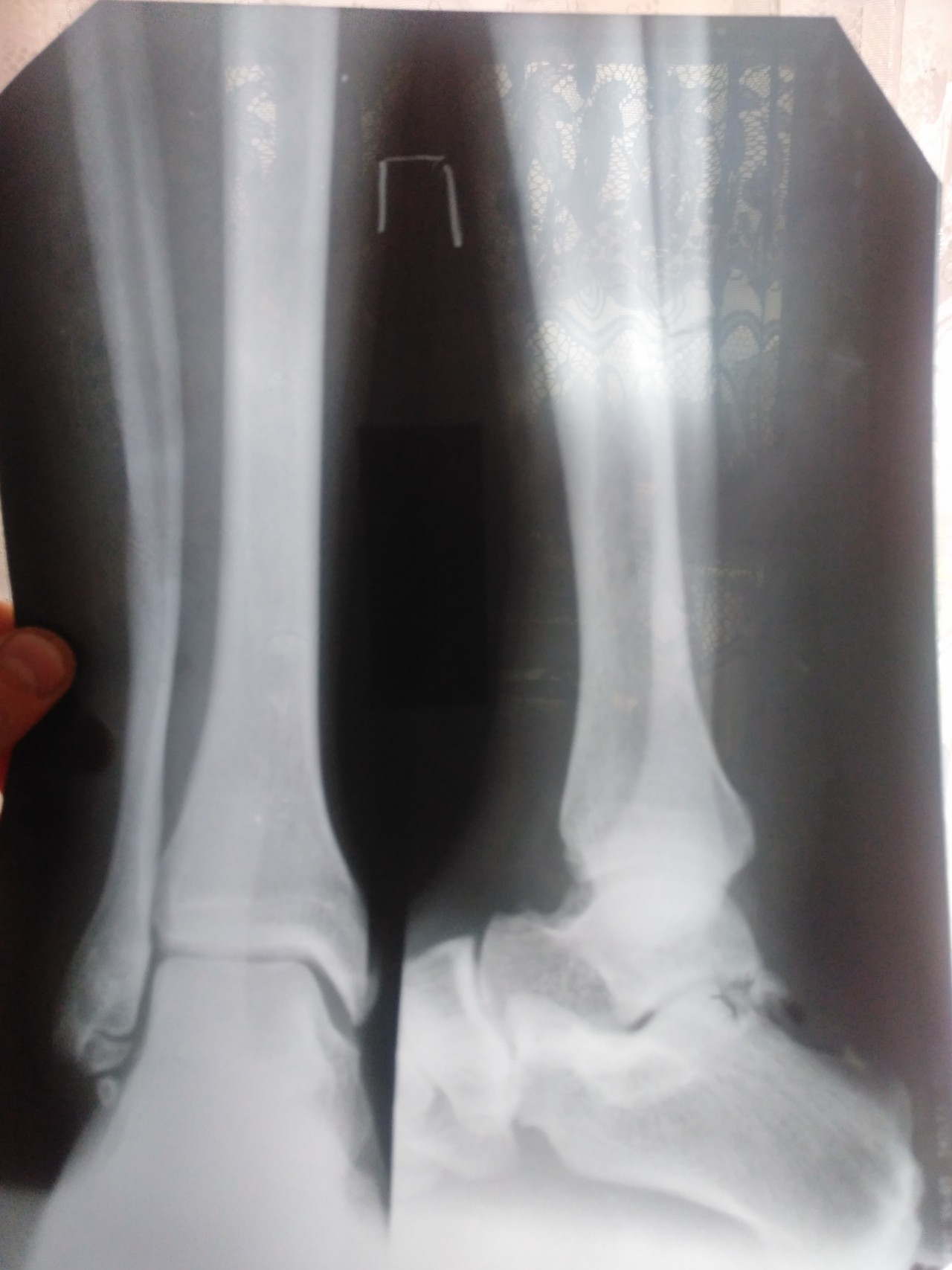 6 недель перелом. Перелом лодыжки рентген. Перелом наружной латеральной лодыжки. Перелом малоберцовой кости гипс.