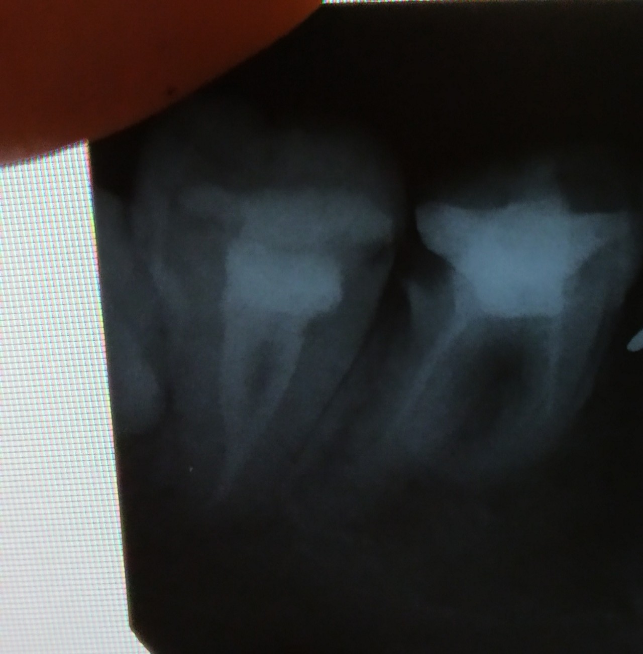 киста зуба лечение фото