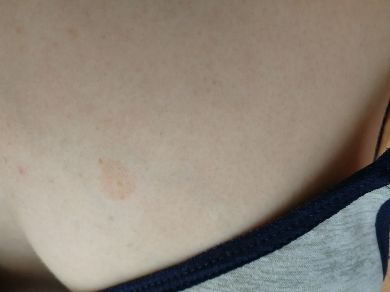 белые пятна на груди у женщин фото 2