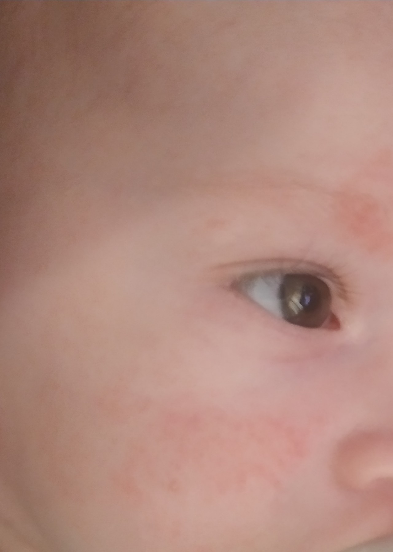 Аллергическая сыпь на лице у ребенка