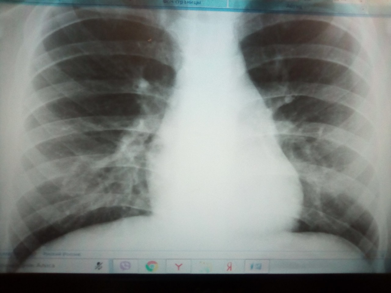фото норма рентгена легких у ребенка