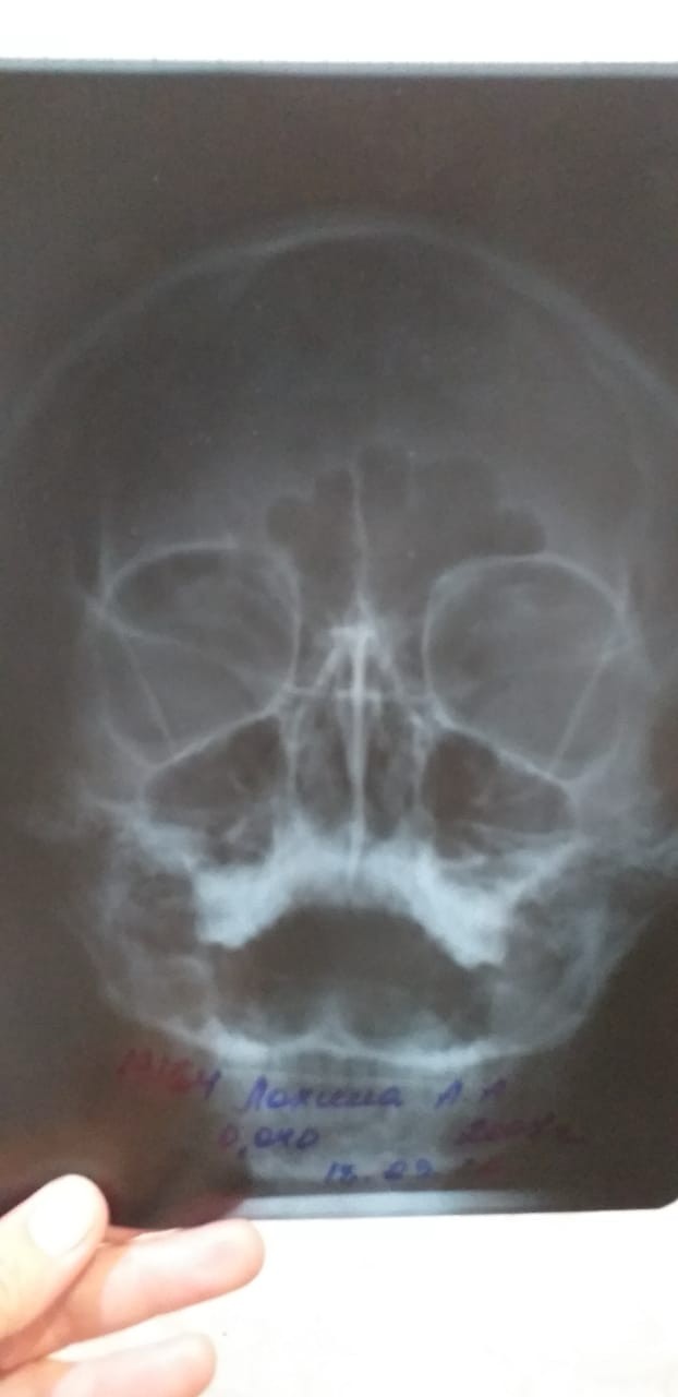Неврома мортона на рентгеновском снимке фото