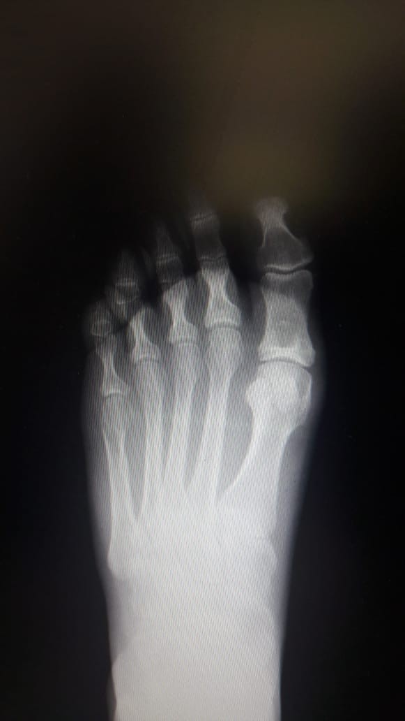 Трещина это перелом. Снимок ноги рентген. Рентген стопы.