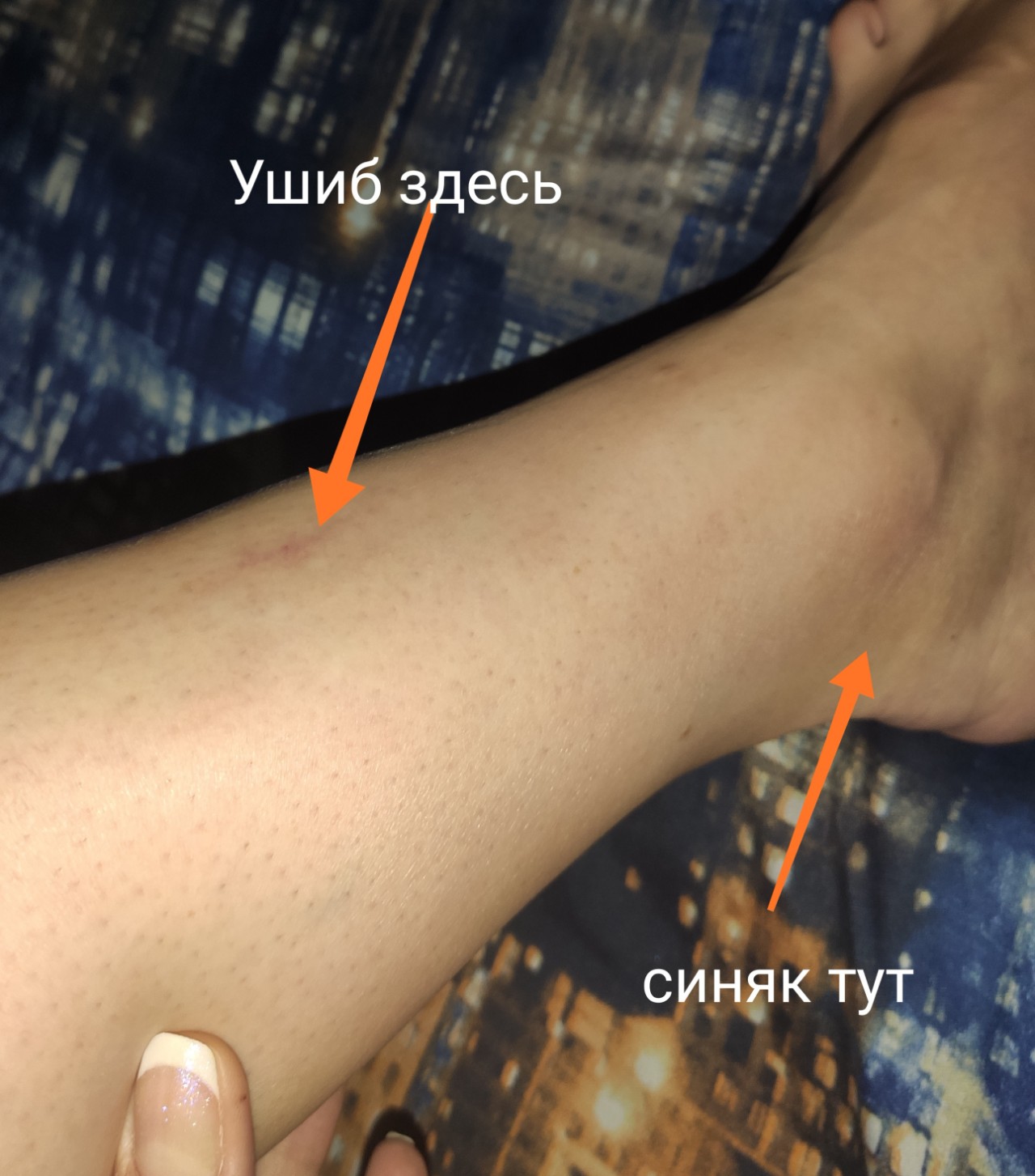 гематома на ноге фото