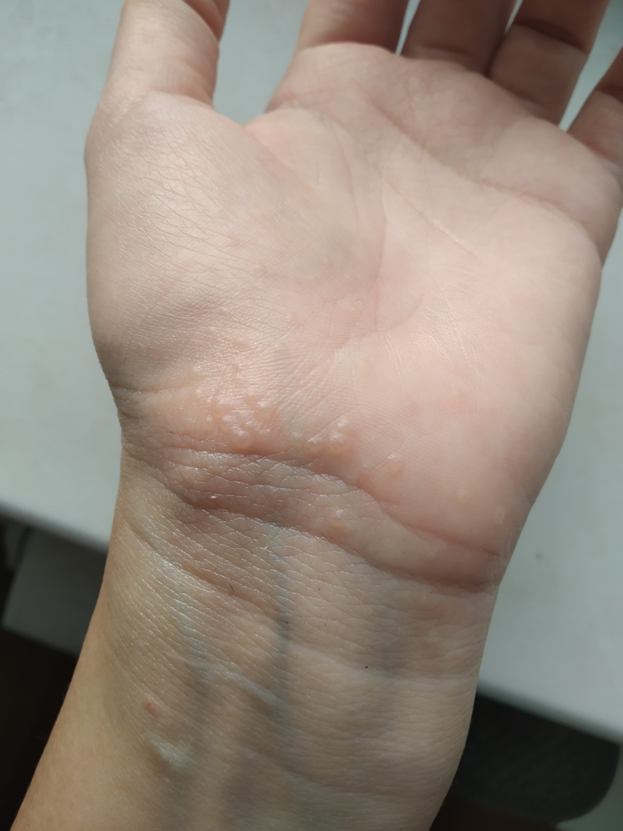 Грибок на коже рук симптомы фото
